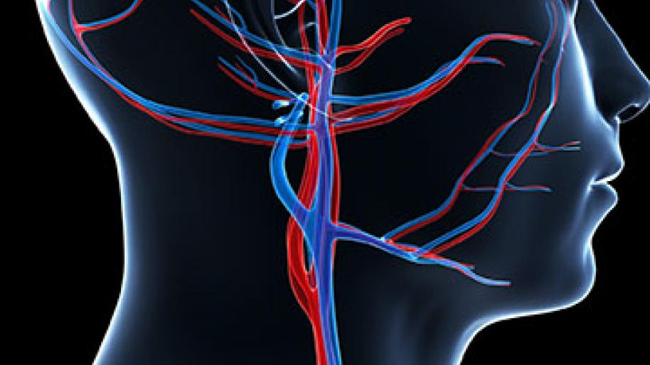 Cerebrovascular Carotid Disease Frankel Cardiovascular Center Michigan Medicine