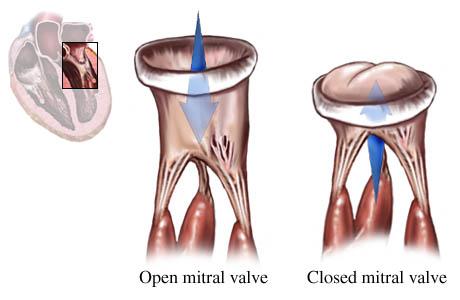 Mitral Valve Disease Frankel Cardiovascular Center Michigan