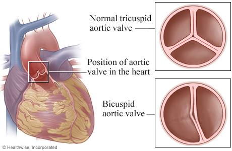 heart valve disease symptoms